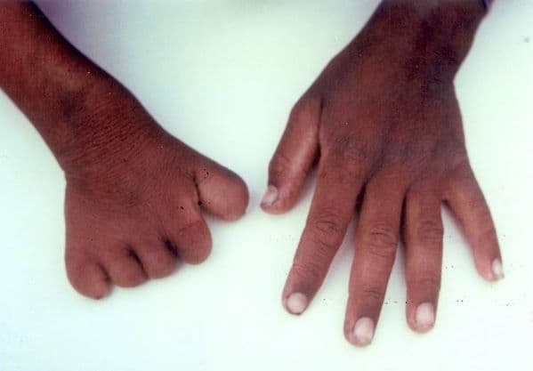A child born with missing fingers and toes corresponding to wounds described in a previous life memory