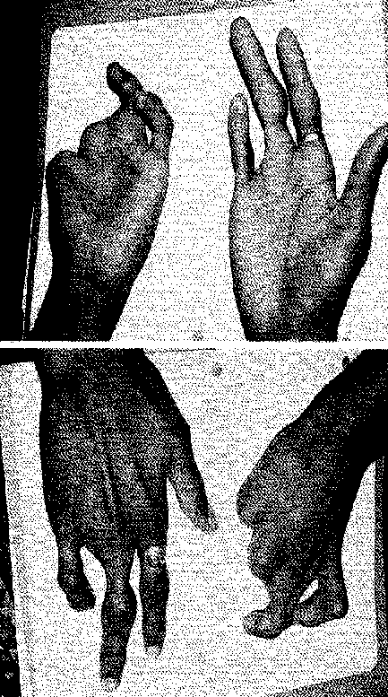 A child born with truncated fingers corresponding precisely to wounds described in memories of a previous life