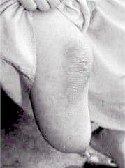 A child born with a malformed foot corresponding to an injury described in a previous life memory