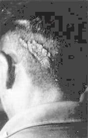 A birthmark on the back of a child's head corresponding to a reported gunshot entry wound in a past life