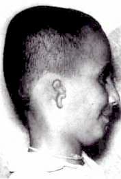 A birthmark on the side of a child's head corresponding to a reported gunshot exit wound in a past life